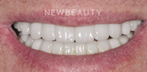 Dr. Salvator La Mastra - Smile Makeover -46106612 - After