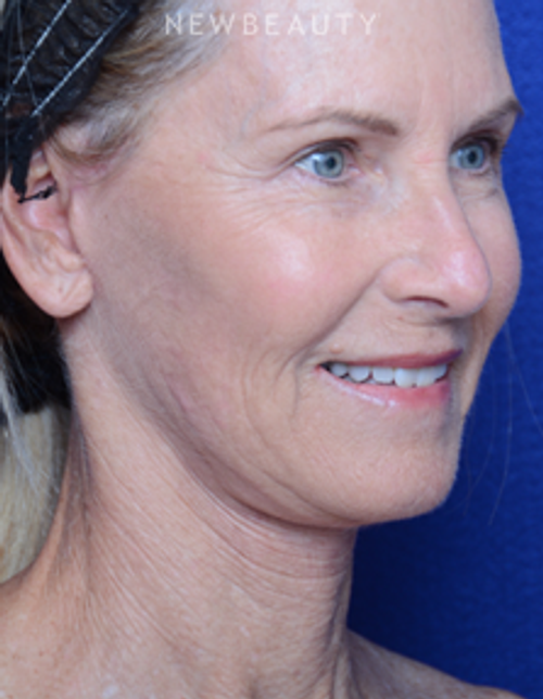 Dr. Alan Durkin - Facelift - After