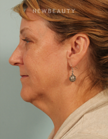 Dr. Kenneth Beer - Kybella - Before