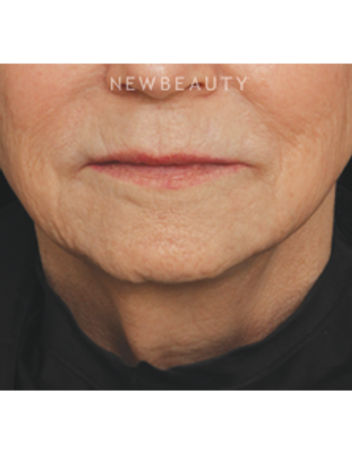 Drs. Jennifer Segal & Scott Smith - Injectables & Fillers - After