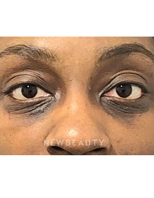 Dr. Dilip Madnani - Lower Blepharoplasty - 13691829 - Before