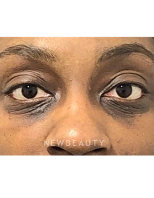 Dr. Dilip Madnani - Lower Blepharoplasty - 13691829 - Before