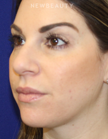 Dr. Dilip Madnani - Facial Rejuvenation - 12950645 - After