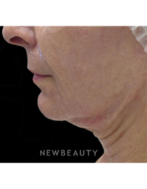 Dr. Kally Papantoniou - Nonsurgical Skin Tightening - Before