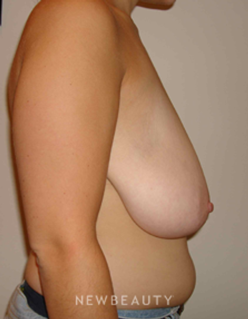 Dr. Michael Horn Breast Reduction - Before