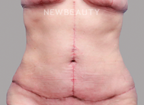 Dr. Michael Lofgren - Tummy Tuck After Weight Loss - 44688404 - After