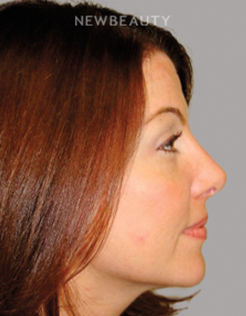Dr. Sanjay Grover - Rhinoplasty - 49727898 - After