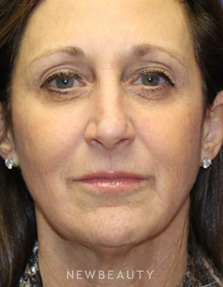 Dr. Dilip Madnani - Facelift - Before