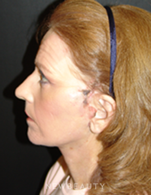 Dr. Mokhtar Asaadi Eyelid Lift, Facelift, Necklift - After