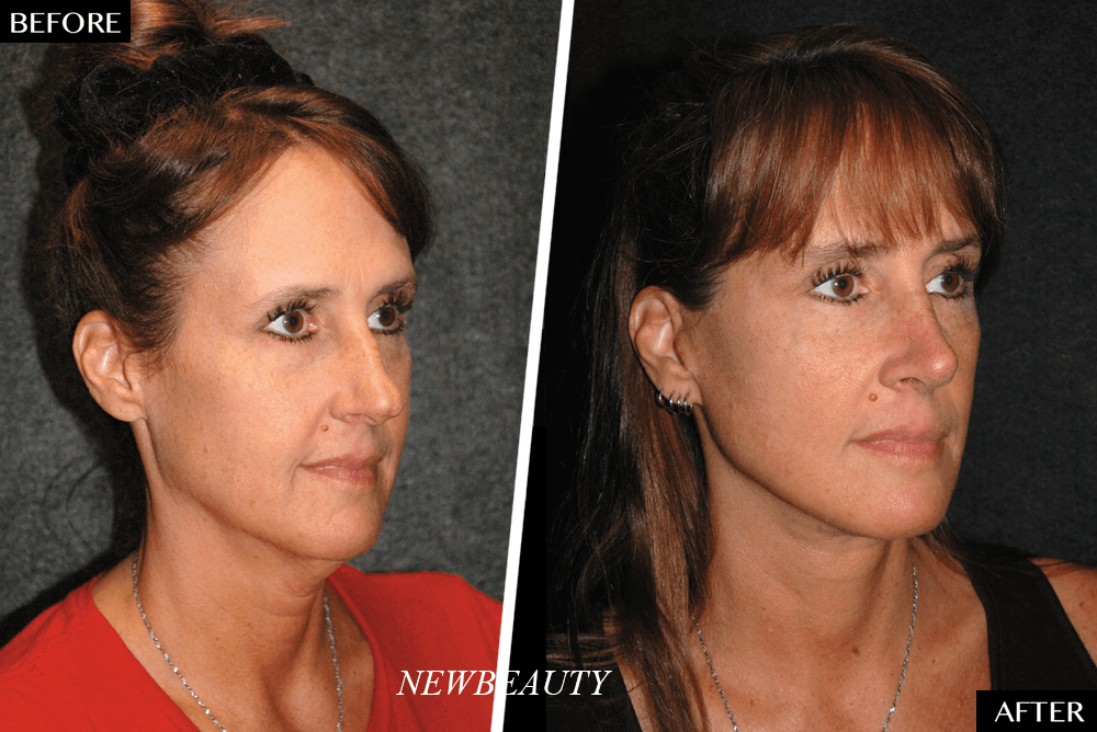 43970 90373 Facelift45main 1pngpng