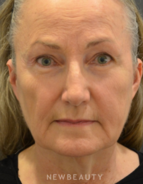 Dr. B. Aviva Preminger - Facelift & Necklift - Before