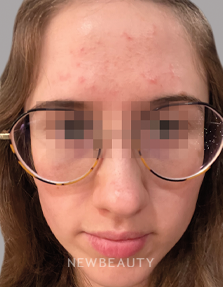 Dr. Anna Chacon - Juvenile Acne - 34284936 - After