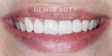 Dr. Nathan Hoffman - Teeth Whitening & Veneers - After