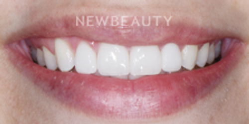 Dr. Nathan Hoffman - Teeth Whitening & Veneers - After