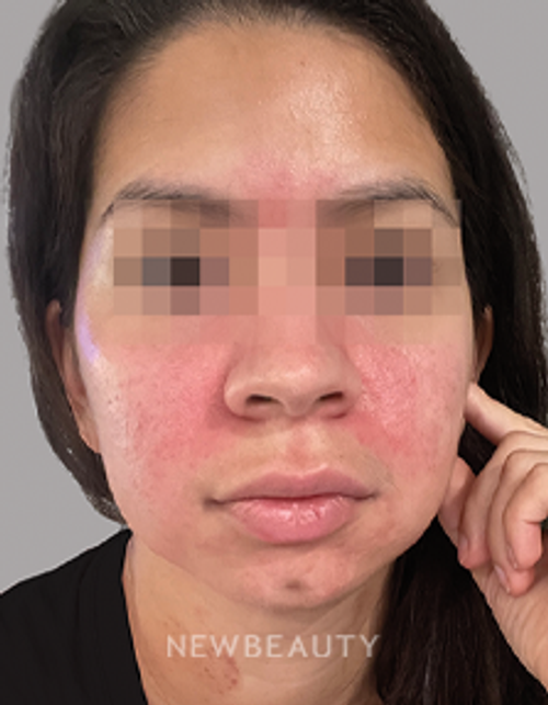 Dr. Anna Chacon - Rosacea / Acne - 34284767 - After