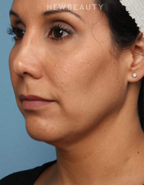 Dr. Kathleen Behr - Kybella & Botox - After