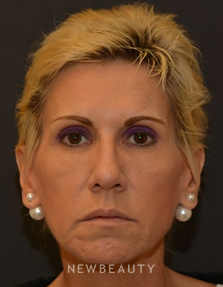 Dr. Janet Allenby - Dysport - Before