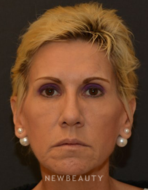 Dr. Janet Allenby - Dysport - Before