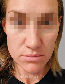 Dr. Anna Chacon – Acne – 34276962 - After