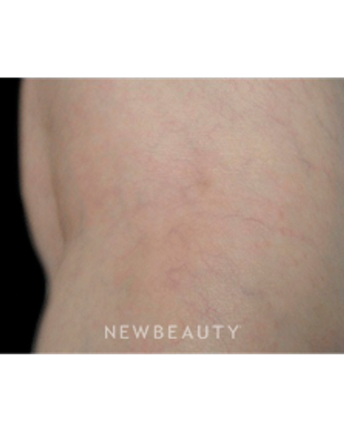 Dr. Marina Peredo - Vein Treatment - After