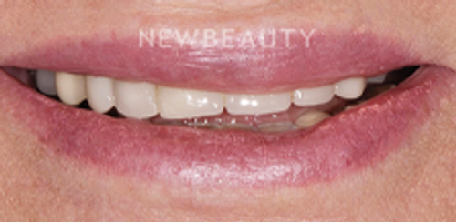Dr. Salvator La Mastra - Smile Makeover -46106922 - Before