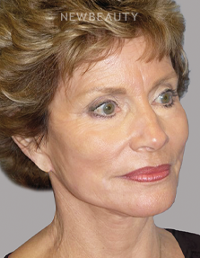 Dr. E. Gaylon McCollough - Ageless Elegance - 44692894 - After