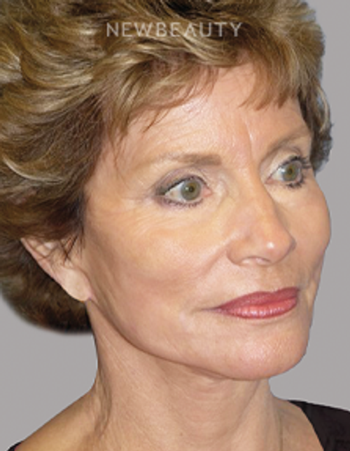 Dr. E. Gaylon McCollough - Ageless Elegance - 44692894 - After