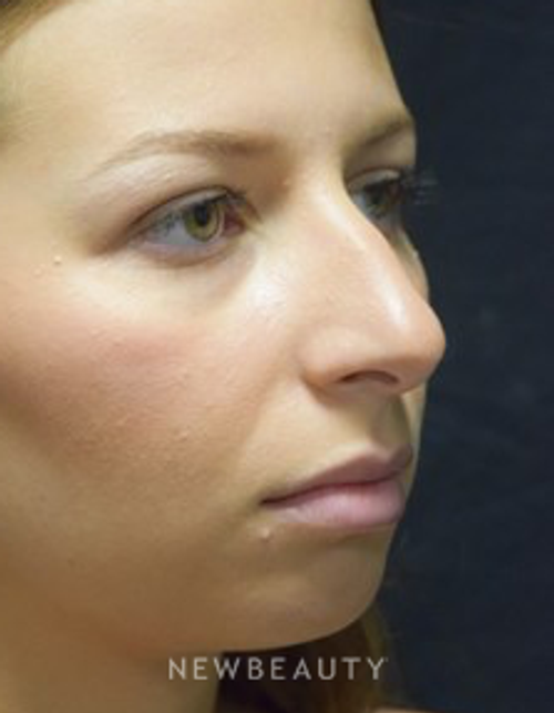Dr. Jeffrey B. Wise - Rhinoplasty - Before