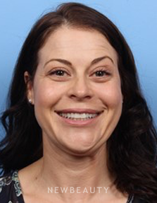 Dr. Kelly Bomer - Dysport - Before