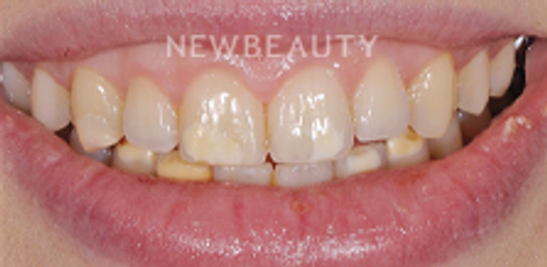 Dr. Salvator La Mastra - Smile Makeover -46106819 - Before
