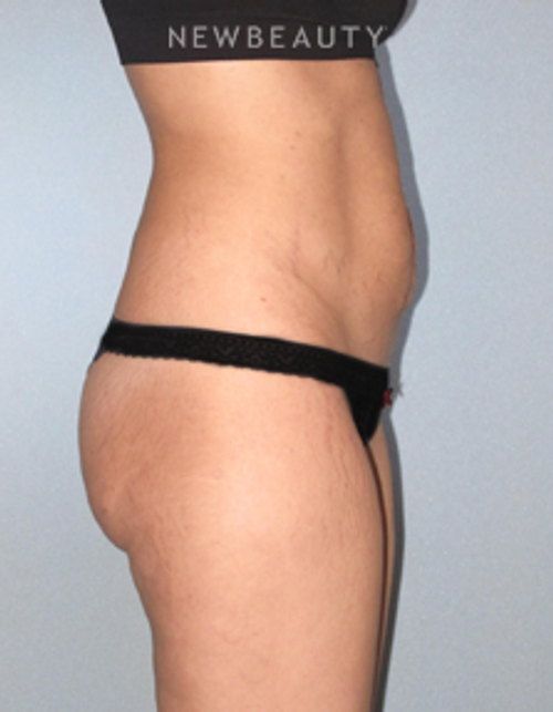 Dr. German Newall - Dramatic Transformation - Before