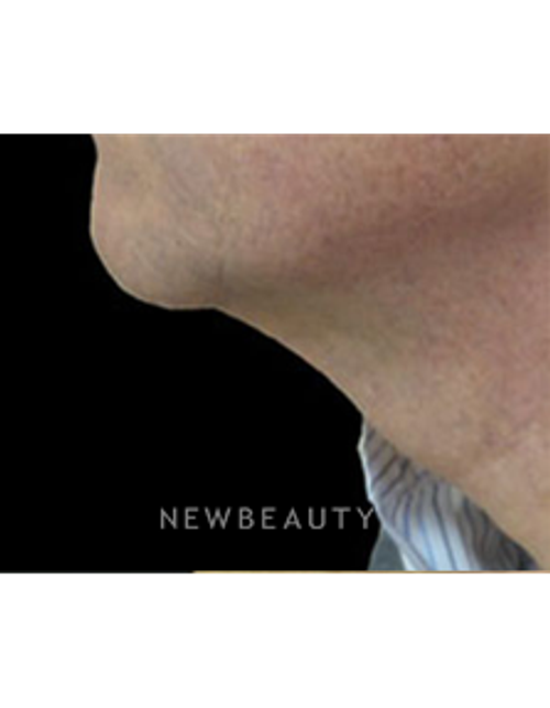 Dr. Christine Hamori - Chin Augmentation - After