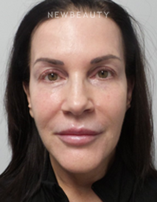 Dr. Marina Peredo - Facelift - After