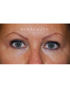 Dr. Roman Rayham - Total Eye Rejuvenation - After
