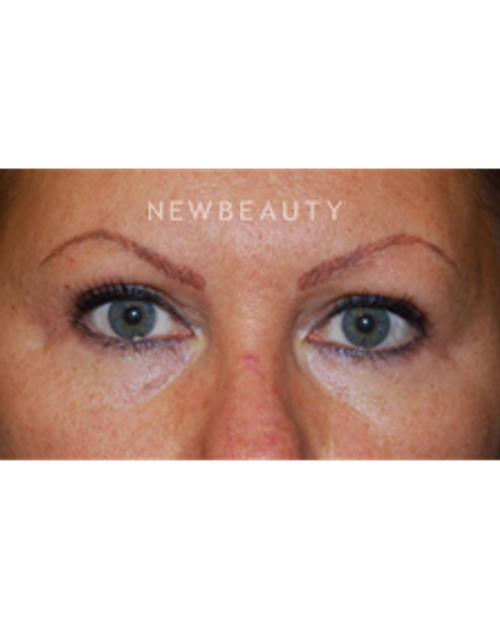 Dr. Roman Rayham - Total Eye Rejuvenation - After