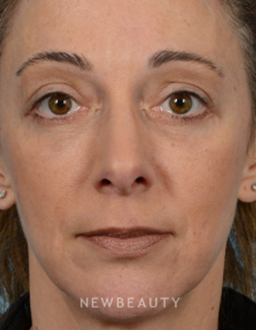 Dr. Jeffrey B. Wise - Lower Blepharoplasty - After