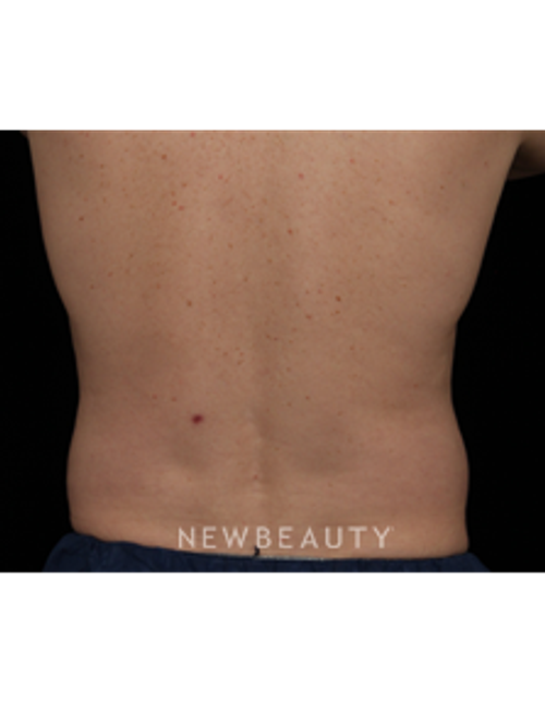 Dr. Jennifer Segal - CoolSculpting - Before