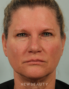 Dr. Kenneth Beer - Liquid Facelift - Before