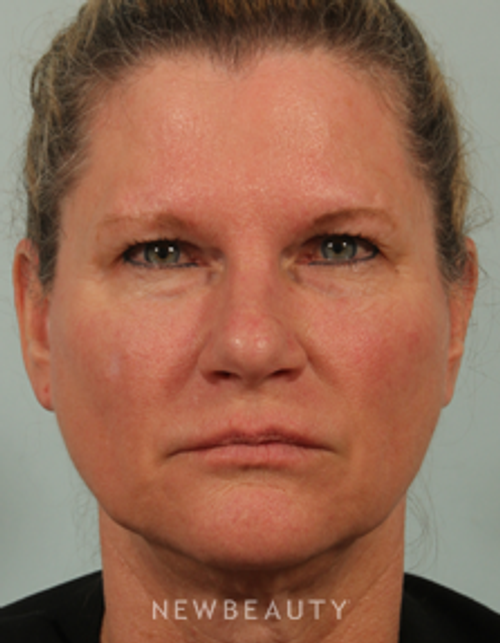 Dr. Kenneth Beer - Liquid Facelift - Before