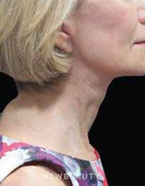 Dr. Elie Levine- Facelift - After