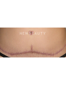 Dr. Sean Simon - Lasers - Before