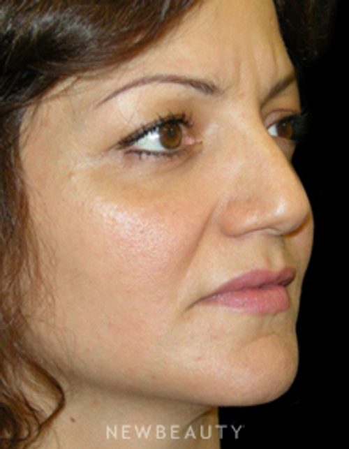 Dr. Elie Levine - Rhinoplasty - Before