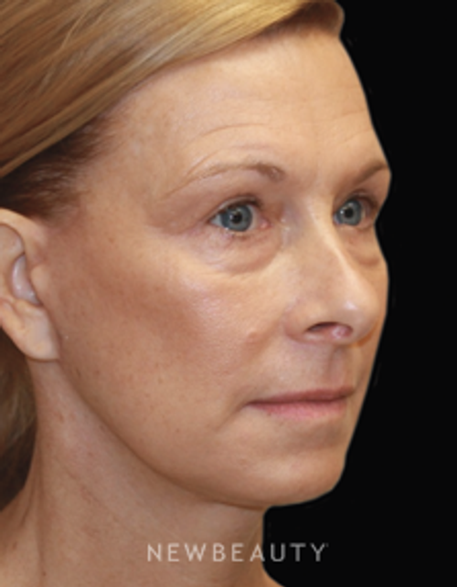 Dr. Dilip Madnani, Facelift - After