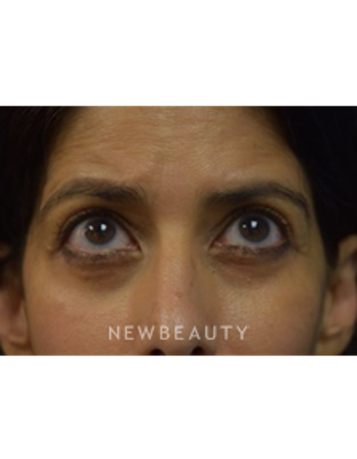 Dr. Jeffrey B. Wise - Blepharoplasty - After