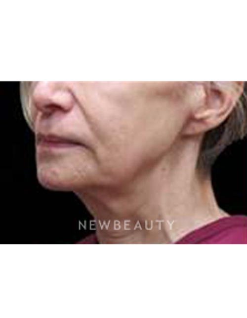 Dr. Elie Levine - Facelift - Before