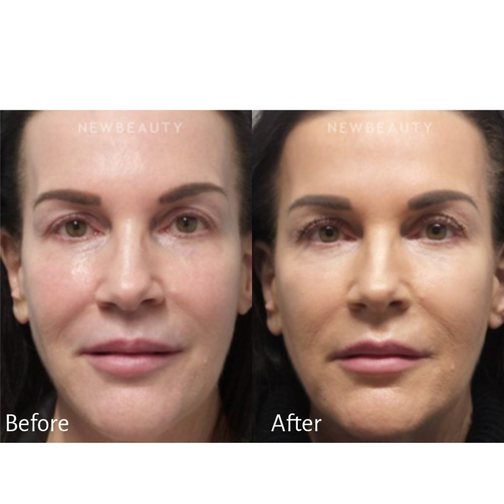 This patient received a nonsurgical facelift with Silhouette InstaLift.