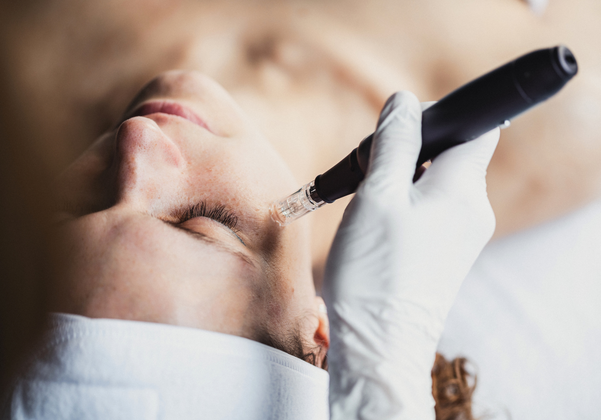 Microneedling procedure on face, a treatment that benefits from post-procedure PDRN recovery