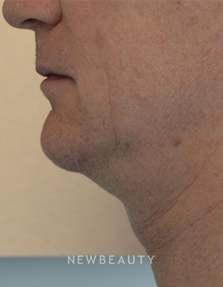 Dr. Julie Russak - Ultherapy - Before