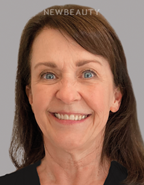 Dr. Sonya L. Wintzell - Vibrant Smile Design - 33124538 - Before