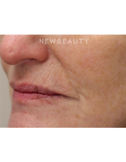 Dr. Gilly Munavalli - Lasers - After